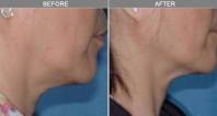 Chicago Laser Wrinkle Reduction